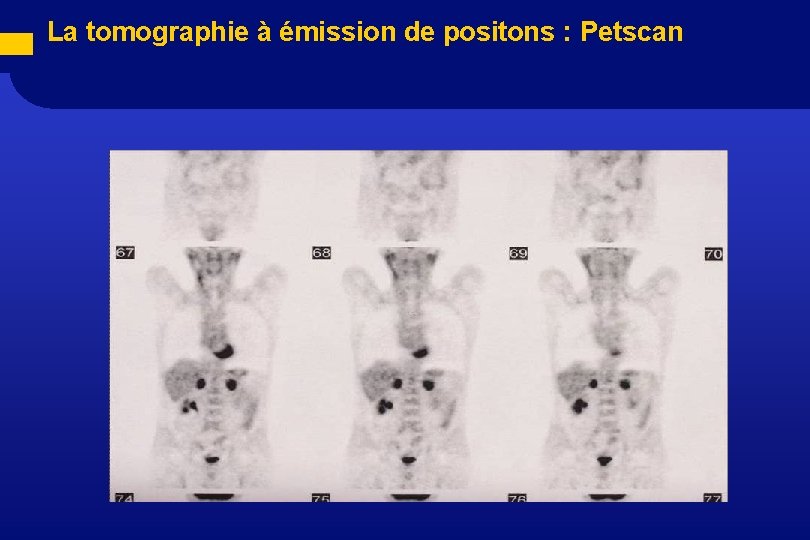 La tomographie à émission de positons : Petscan 