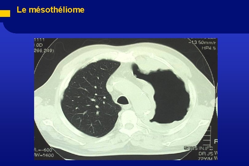  Le mésothéliome 