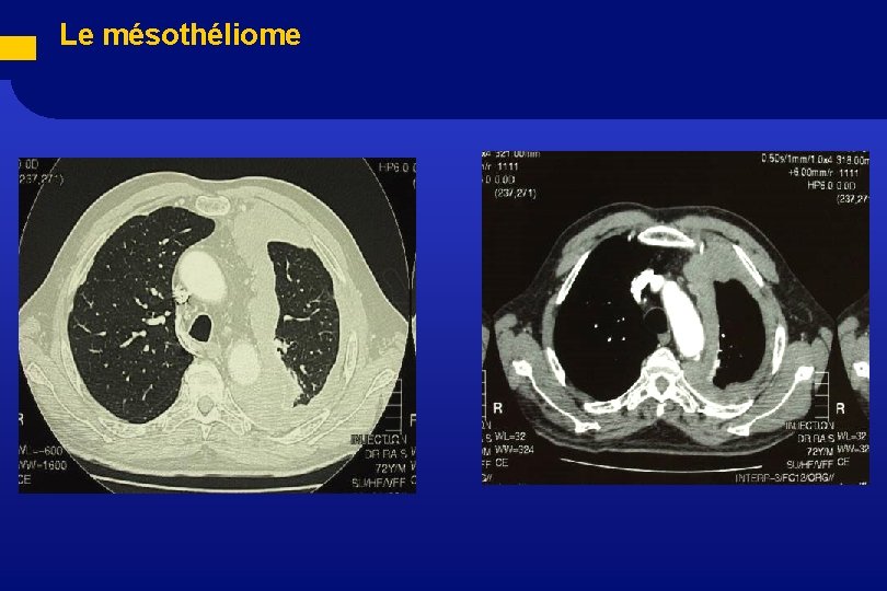  Le mésothéliome 