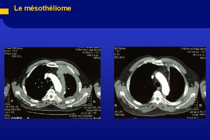  Le mésothéliome 