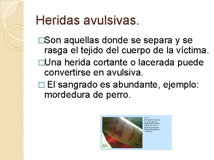 Heridas avulsivas. �Son aquellas donde se separa y se rasga el tejido del cuerpo
