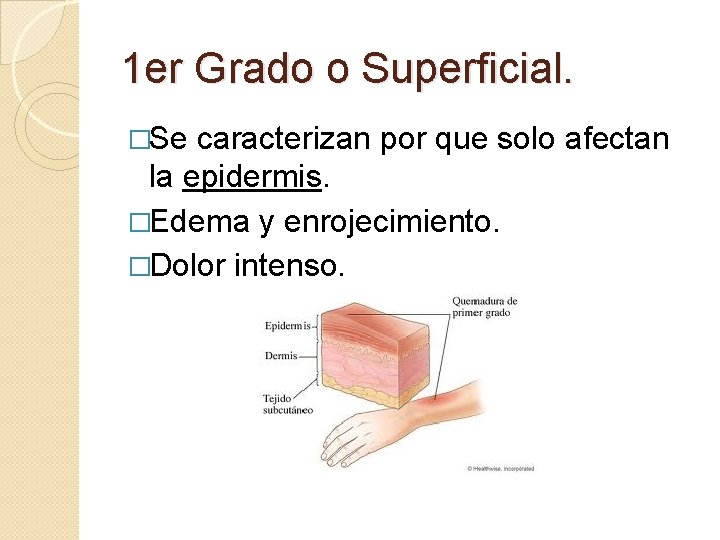 1 er Grado o Superficial. �Se caracterizan por que solo afectan la epidermis. �Edema