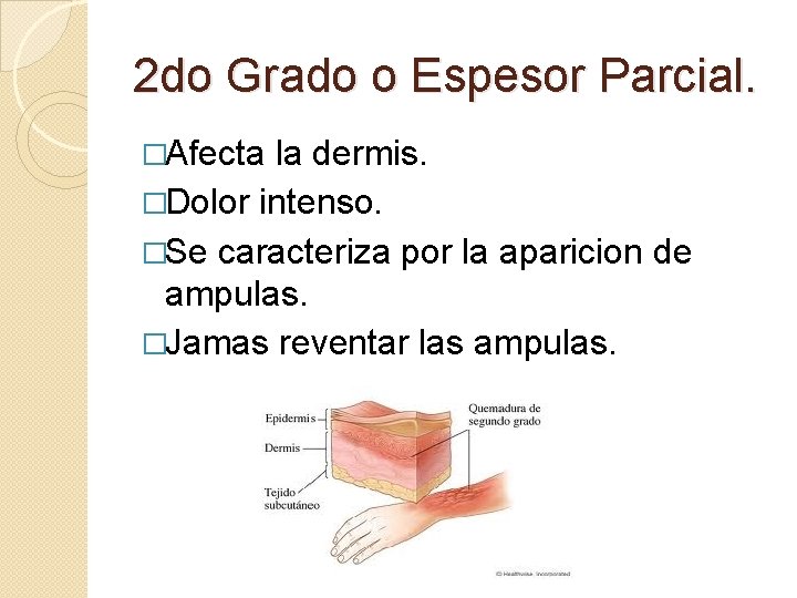 2 do Grado o Espesor Parcial. �Afecta la dermis. �Dolor intenso. �Se caracteriza por