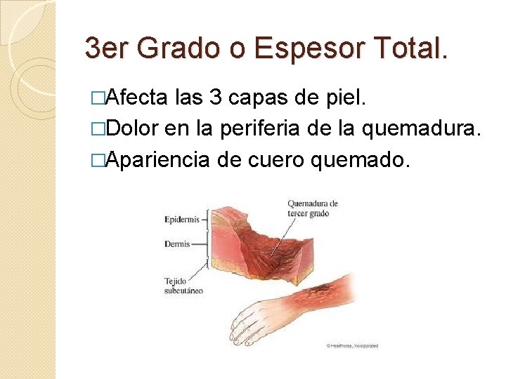 3 er Grado o Espesor Total. �Afecta las 3 capas de piel. �Dolor en