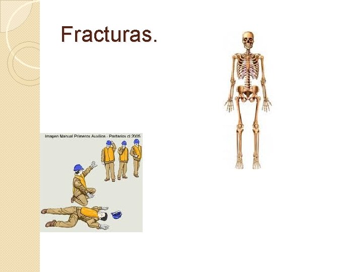 Fracturas. 
