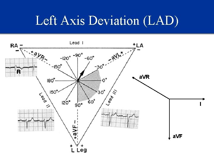 Left Axis Deviation (LAD) a. VR I a. VF 