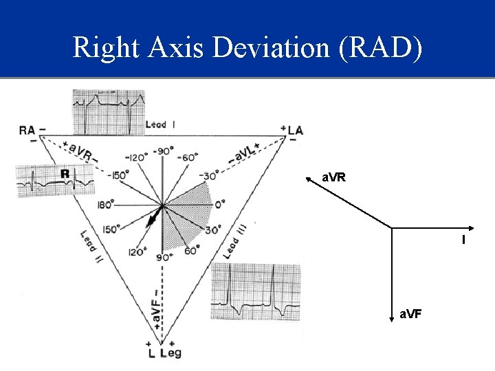 Right Axis Deviation (RAD) a. VR I a. VF 