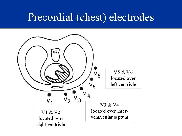 Precordial (chest) electrodes V 5 & V 6 located over left ventricle V 1