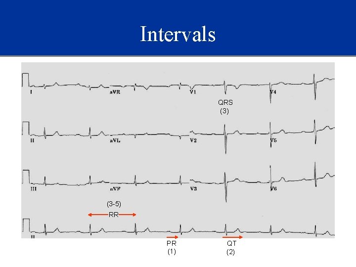 Intervals QRS (3) (3 -5) RR PR (1) QT (2) 