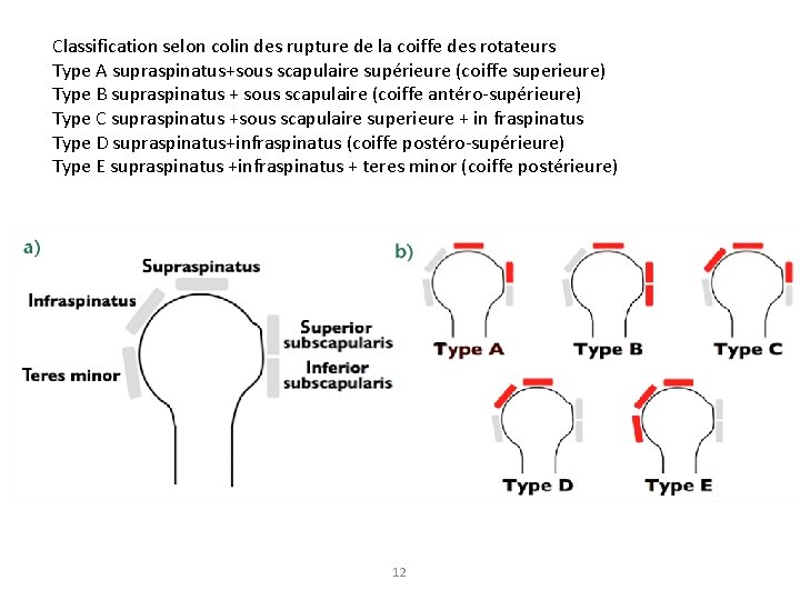 Classification selon colin des rupture de la coiffe des rotateurs Type A supraspinatus+sous scapulaire