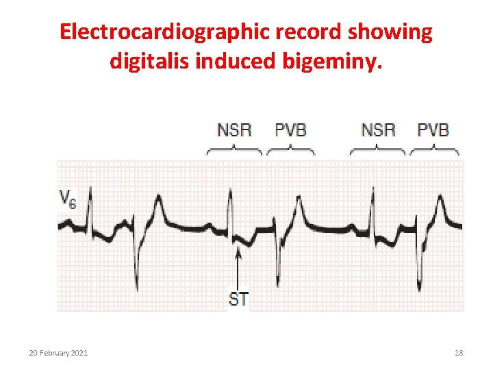 Electrocardiographic record showing digitalis induced bigeminy. 20 February 2021 18 