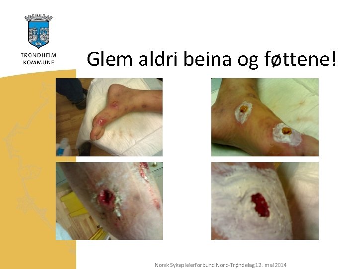 Glem aldri beina og føttene! Norsk Sykepleierforbund Nord-Trøndelag 12. mai 2014 