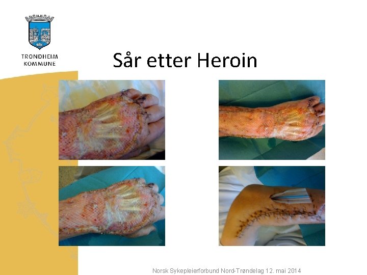 Sår etter Heroin Norsk Sykepleierforbund Nord-Trøndelag 12. mai 2014 