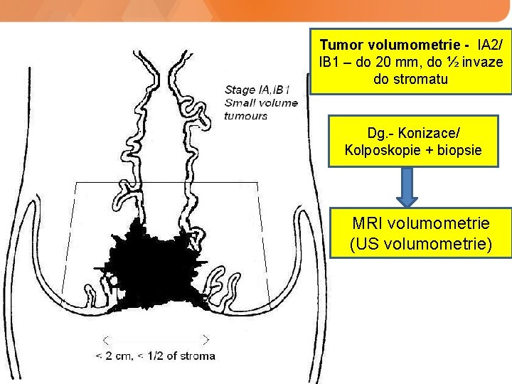 Tumor volumometrie - IA 2/ IB 1 – do 20 mm, do ½ invaze