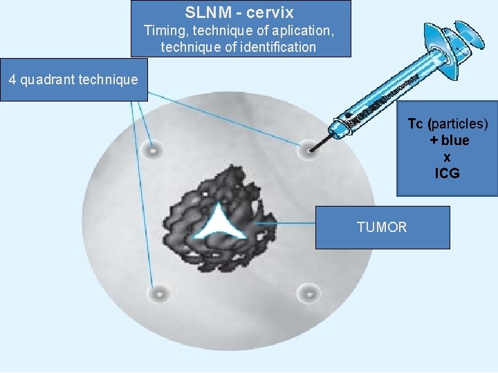 SLNM - cervix Timing, technique of aplication, technique of identification 4 quadrant technique Tc