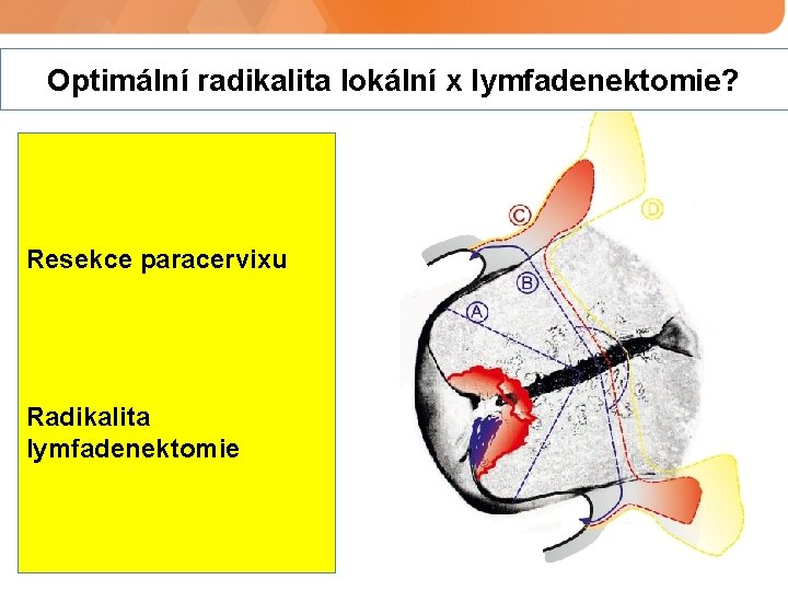 Optimální radikalita lokální x lymfadenektomie? Resekce paracervixu Radikalita lymfadenektomie 