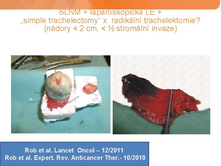 SLNM + laparoskopická LE + „simple trachelectomy“ x radikální trachelektomie? (nádory < 2 cm,