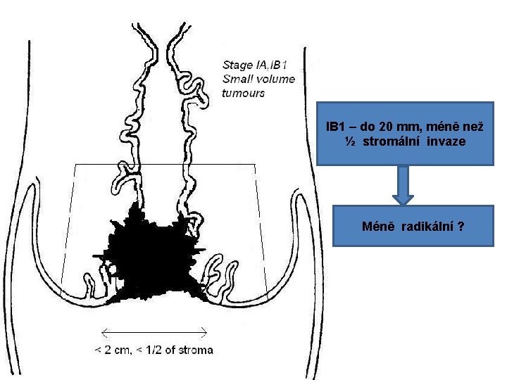 IB 1 – do 20 mm, méně než ½ stromální invaze Méně radikální ?