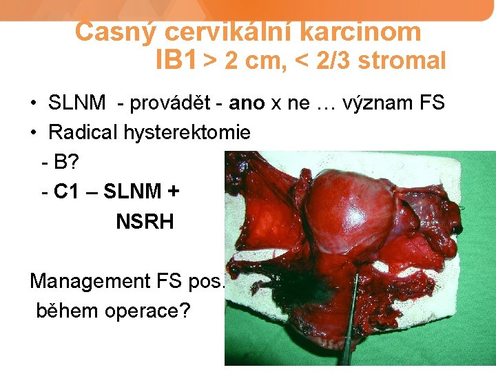 Časný cervikální karcinom IB 1 > 2 cm, < 2/3 stromal • SLNM -