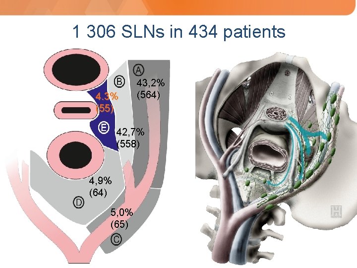 1 306 SLNs in 434 patients 4. 3% (55) 43, 2% (564) 42, 7%