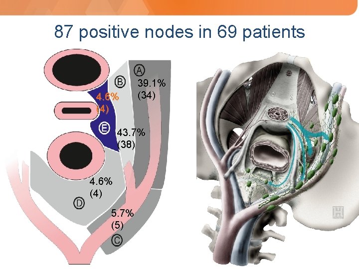 87 positive nodes in 69 patients 4. 6% (4) 39. 1% (34) 43. 7%