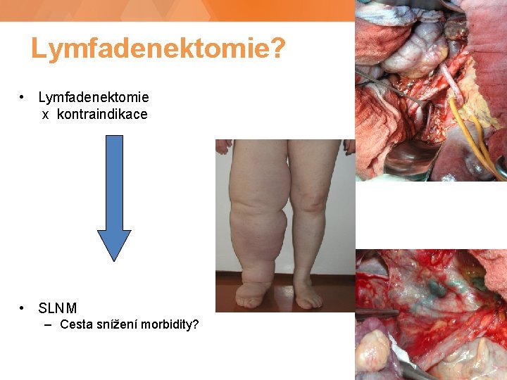 Lymfadenektomie? • Lymfadenektomie x kontraindikace • SLNM – Cesta snížení morbidity? h 