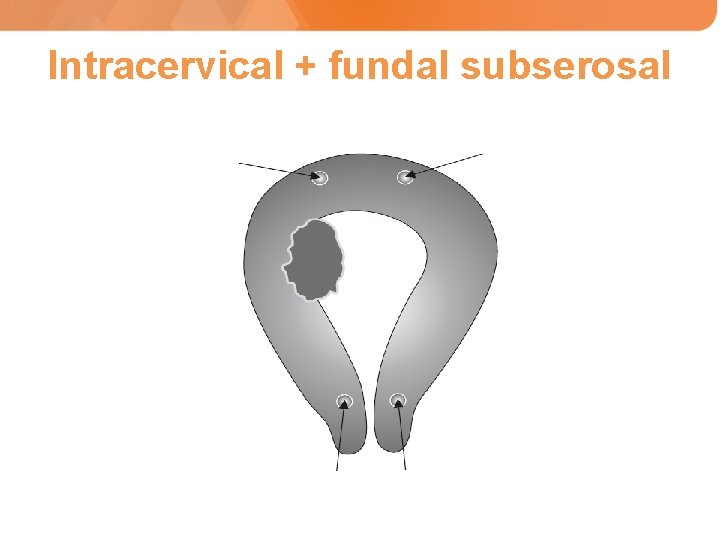 Intracervical + fundal subserosal 