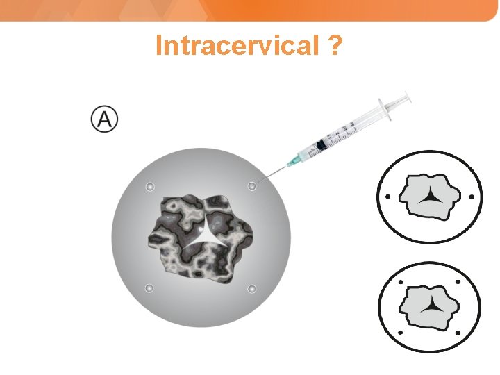 Intracervical ? 