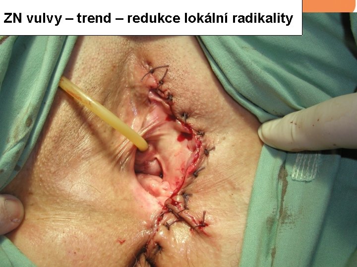 ZN vulvy – trend – redukce lokální radikality 