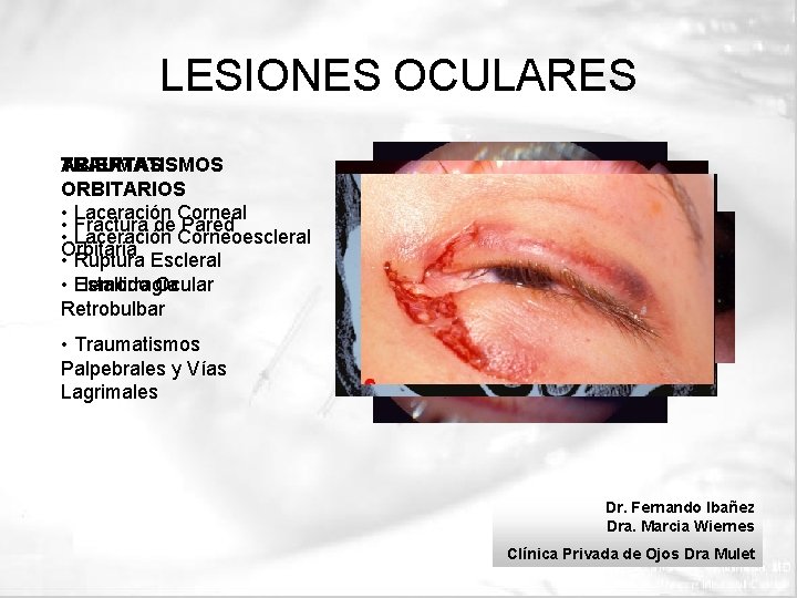 LESIONES OCULARES TRAUMATISMOS ABIERTAS ORBITARIOS • Laceración Corneal • Fractura de Pared • Laceración