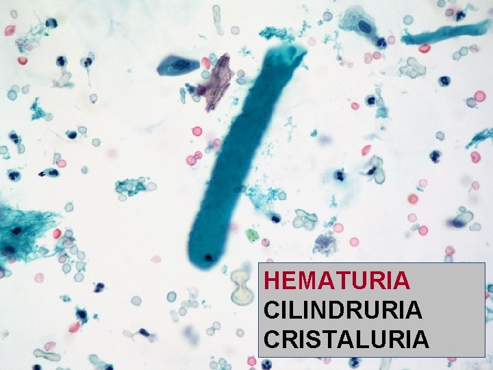 HEMATURIA CILINDRURIA CRISTALURIA 