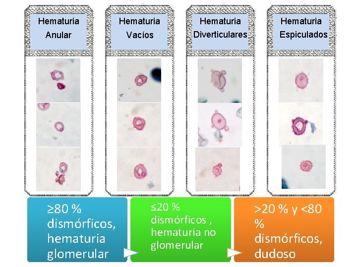 Hematuria Anular Vacíos Diverticulares Espiculados ≥ 80 % dismórficos, hematuria glomerular ≤ 20 %