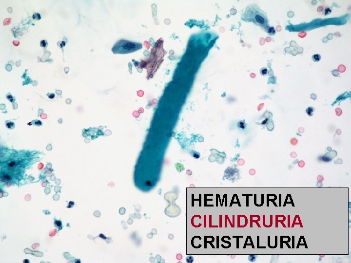 HEMATURIA CILINDRURIA CRISTALURIA 