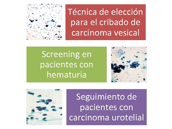 Técnica de elección para el cribado de carcinoma vesical Screening en pacientes con hematuria