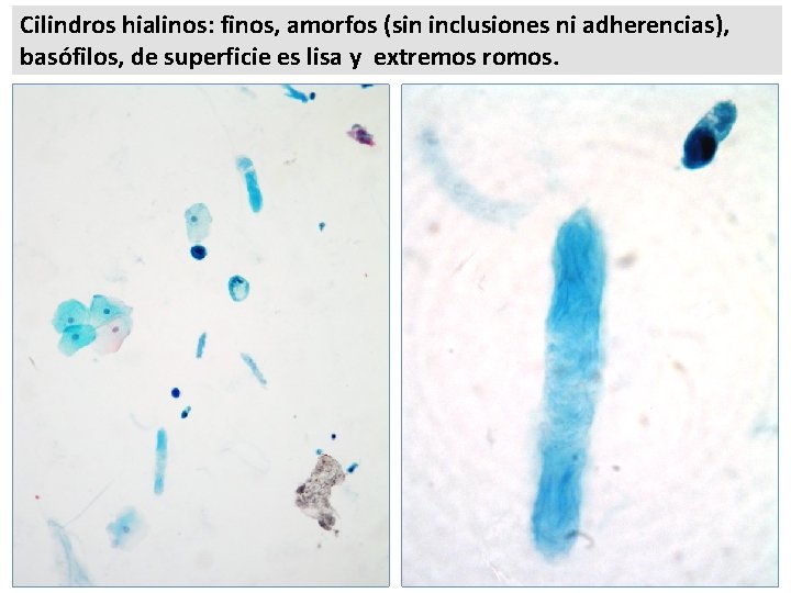 Cilindros hialinos: finos, amorfos (sin inclusiones ni adherencias), basófilos, de superficie es lisa y