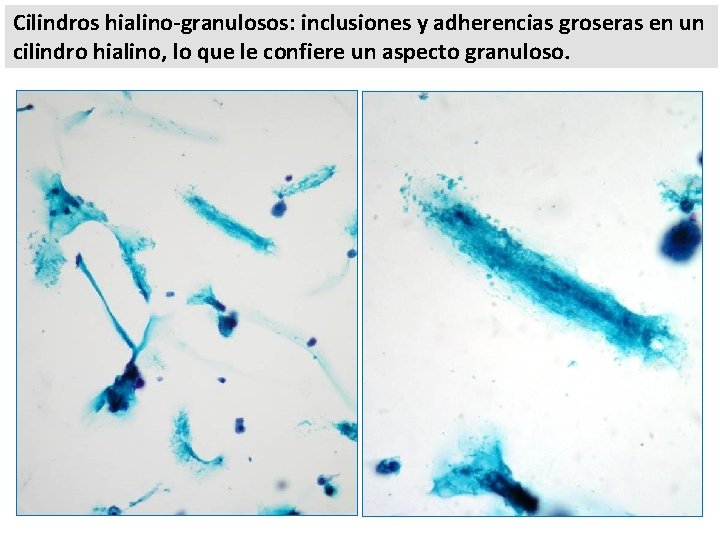 Cilindros hialino-granulosos: inclusiones y adherencias groseras en un cilindro hialino, lo que le confiere