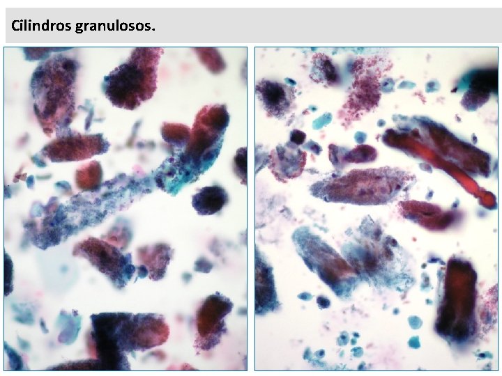 Cilindros granulosos. 