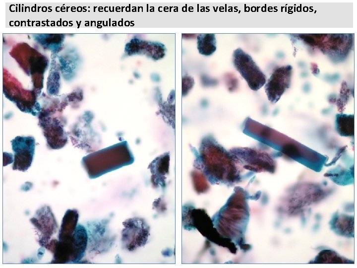 Cilindros céreos: recuerdan la cera de las velas, bordes rígidos, contrastados y angulados 