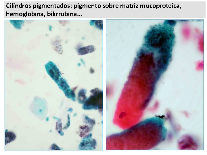 Cilindros pigmentados: pigmento sobre matriz mucoproteica, hemoglobina, bilirrubina. . . 