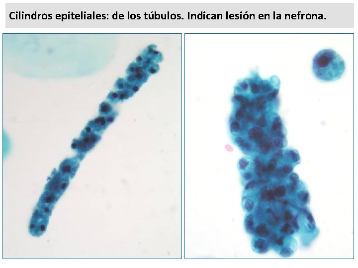 Cilindros epiteliales: de los túbulos. Indican lesión en la nefrona. 