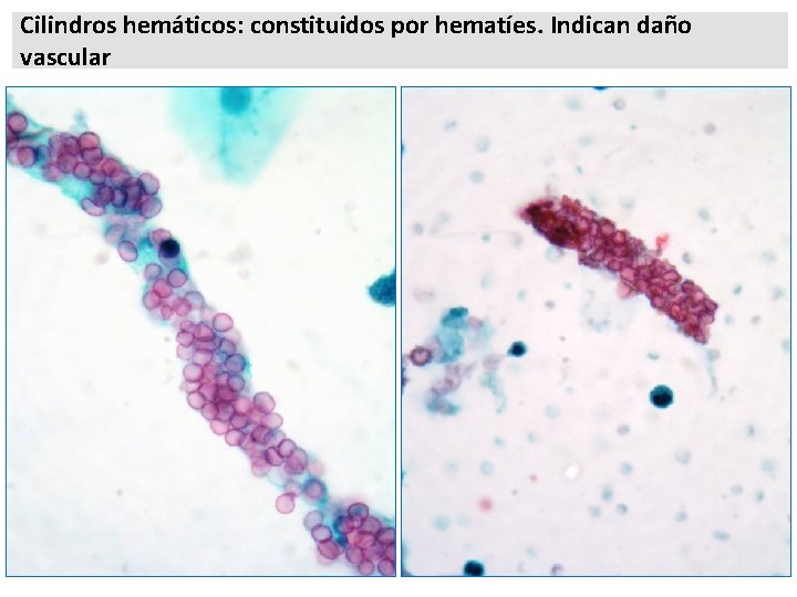 Cilindros hemáticos: constituidos por hematíes. Indican daño vascular 