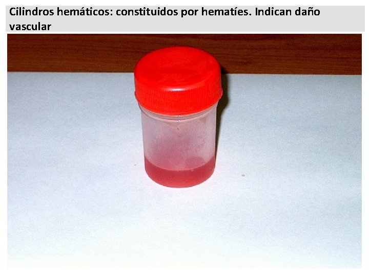 Cilindros hemáticos: constituidos por hematíes. Indican daño vascular 