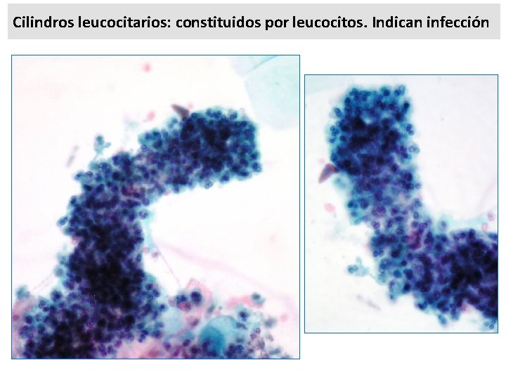 Cilindros leucocitarios: constituidos por leucocitos. Indican infección 