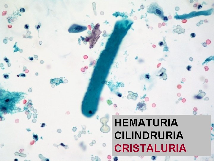 HEMATURIA CILINDRURIA CRISTALURIA 