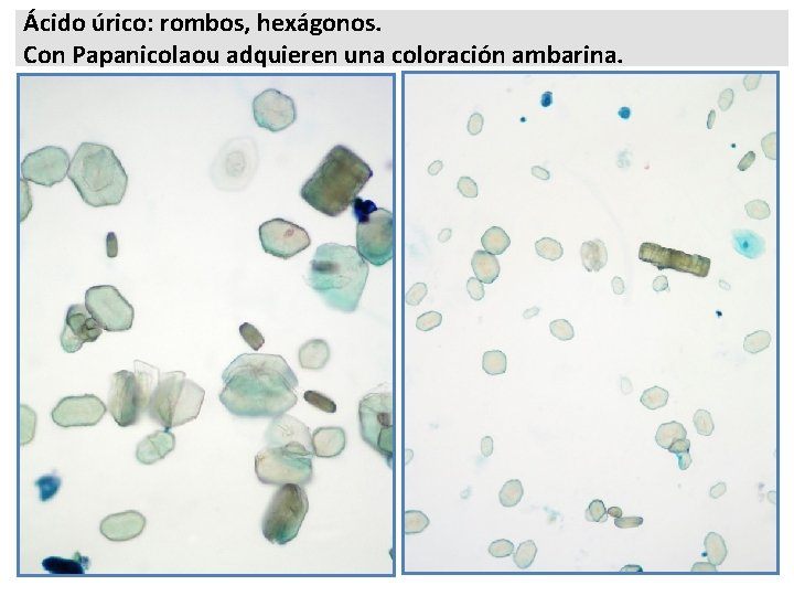 Ácido úrico: rombos, hexágonos. Con Papanicolaou adquieren una coloración ambarina. 