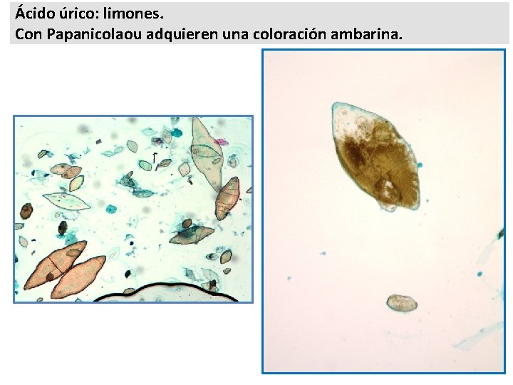 Ácido úrico: limones. Con Papanicolaou adquieren una coloración ambarina. 