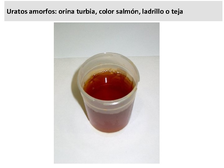 Uratos amorfos: orina turbia, color salmón, ladrillo o teja 