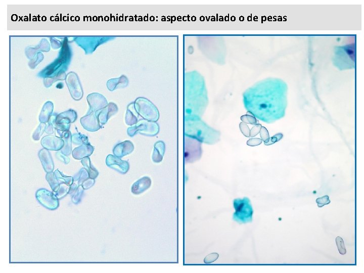 Oxalato cálcico monohidratado: aspecto ovalado o de pesas 