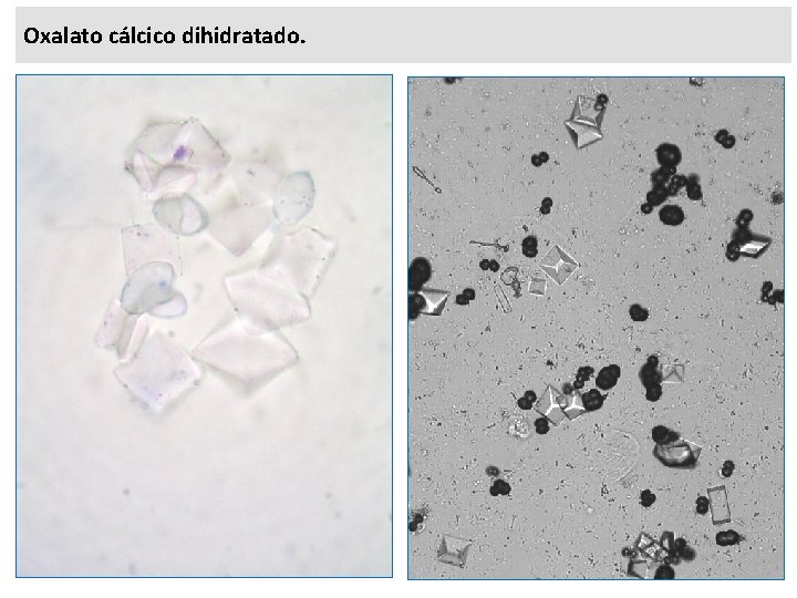 Oxalato cálcico dihidratado. 