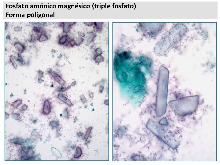 Fosfato amónico magnésico (triple fosfato) Forma poligonal 